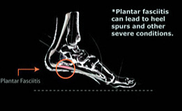 Plantar